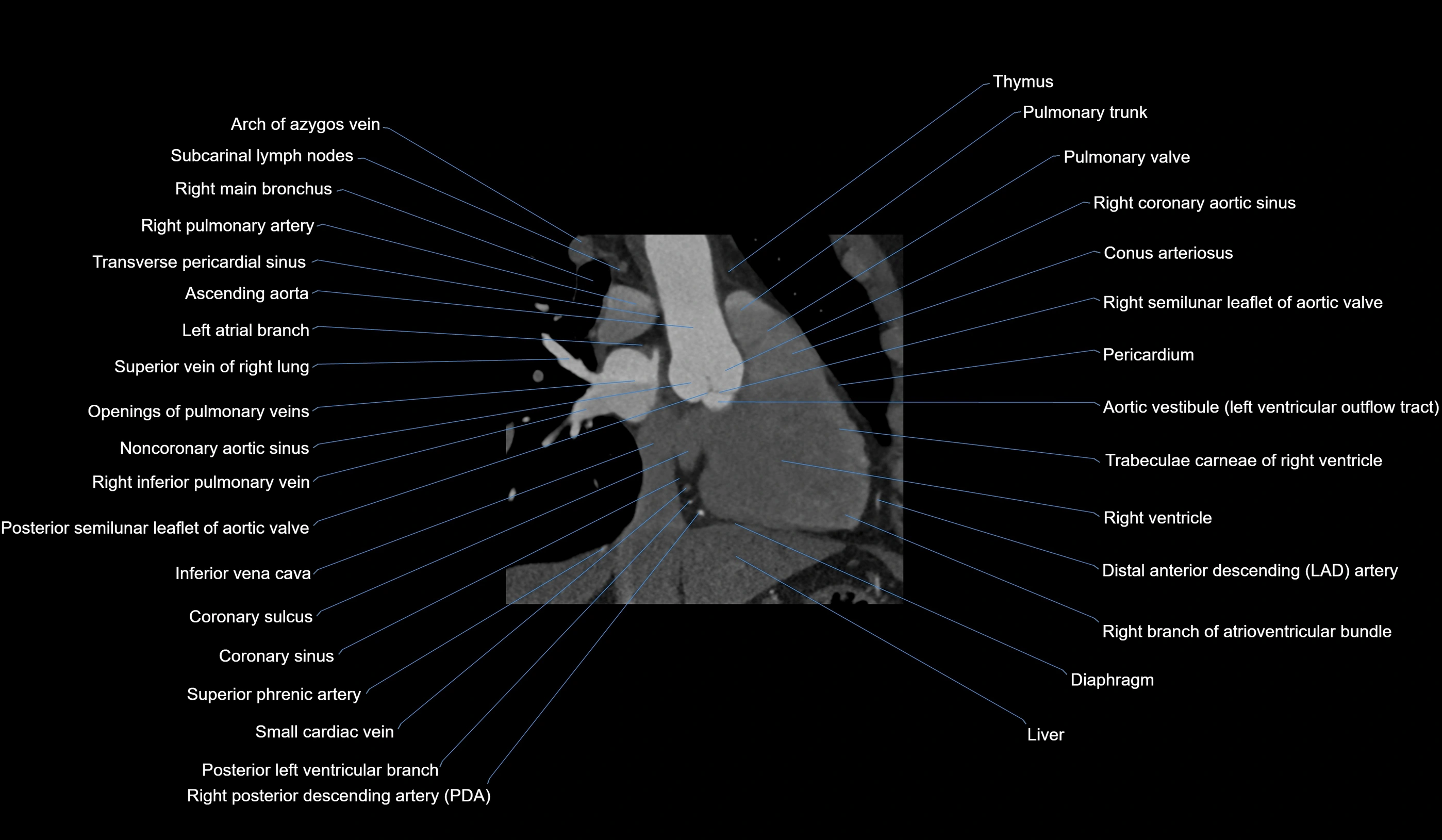 CT heart (coronary angiogram) 2 chamber view cross sectional anatomy labelled radiology image-00024.webp